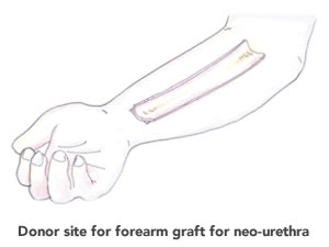 Combined ALT/Forearm Phalloplasty